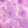 Scottish Scientists Uncover How Breast Cancer Cells Evade Immune System to Spread – 'This Discovery Could Revolutionize Treatment' Says Lead Researcher, Published in *Embo Reports*
