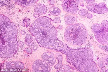 Scottish Scientists Uncover How Breast Cancer Cells Evade Immune System to Spread – 'This Discovery Could Revolutionize Treatment' Says Lead Researcher, Published in *Embo Reports*