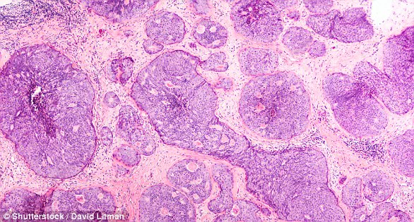 Scottish Scientists Uncover How Breast Cancer Cells Evade Immune System to Spread – 'This Discovery Could Revolutionize Treatment' Says Lead Researcher, Published in *Embo Reports*