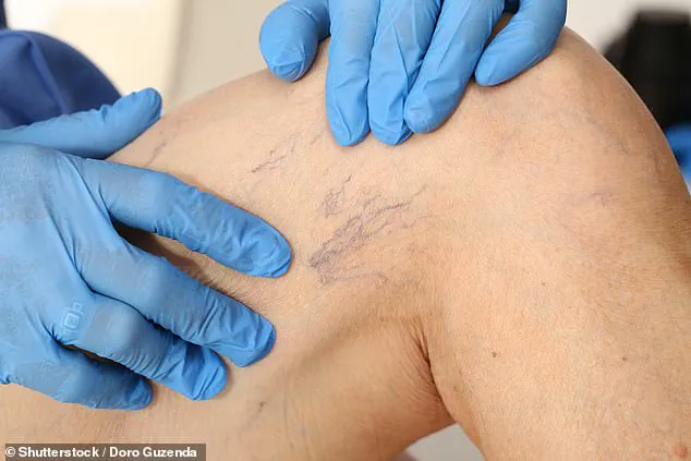 Understanding Thread Veins: A Common Cosmetic Concern with Limited NHS Treatment Options