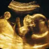 AI-Driven Ultrasound Predicts Birth Dates with 95% Accuracy, Challenging Traditional Methods