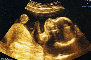 AI-Driven Ultrasound Predicts Birth Dates with 95% Accuracy, Challenging Traditional Methods