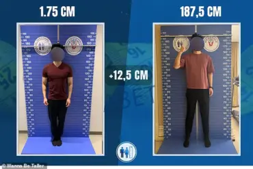 How 'Materialists' Ignited Debate on Leg Lengthening Surgery and Height Alteration