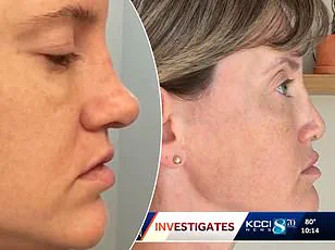Lawsuit Over Breast Lift and Enlargement Procedure at The Secret Plastic Surgery Clinic Raises Concerns About Cosmetic Surgery Safety and Surgeon Responsibility