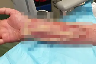 Life-Threatening Infection After Accidental Dog Bite: 'It Was a Complete Accident' Says Australian Man