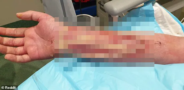 Life-Threatening Infection After Accidental Dog Bite: 'It Was a Complete Accident' Says Australian Man