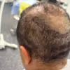 Urgent Warnings: Black Market Hair Transplants Surge in UK, BAHRS Warns of Rising Health Risks