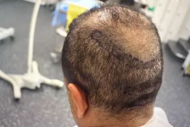 Urgent Warnings: Black Market Hair Transplants Surge in UK, BAHRS Warns of Rising Health Risks