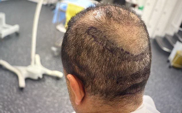 Urgent Warnings: Black Market Hair Transplants Surge in UK, BAHRS Warns of Rising Health Risks