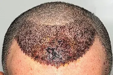 Warning: Cheap Hair Transplants Pose Irreversible Risks, Says Dallas Surgeon Dr. Abraham Armani
