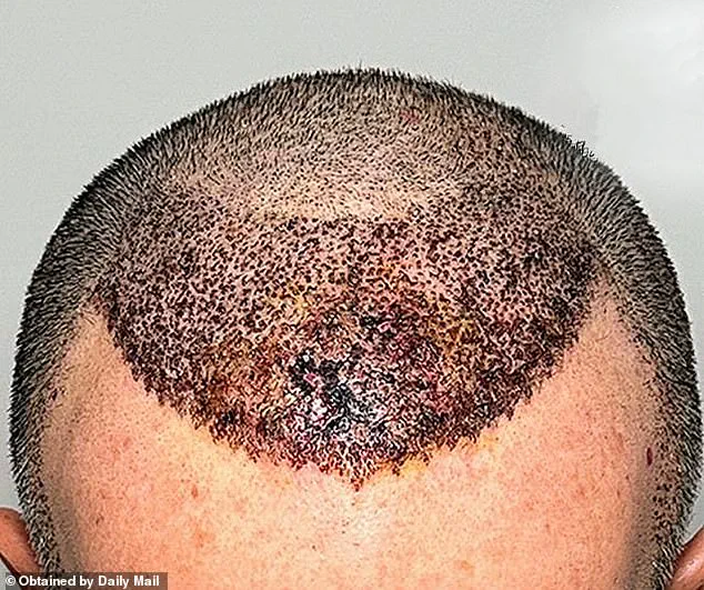 Warning: Cheap Hair Transplants Pose Irreversible Risks, Says Dallas Surgeon Dr. Abraham Armani