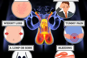 Warning: Gynecomastia May Signal Life-Threatening Conditions Like Testicular Cancer, Breast Cancer, or Liver Disease, Experts Urge Immediate Attention