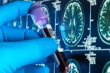 Breakthrough Blood Test Trial Offers Early Alzheimer's Detection, Transforming Dementia Care in the UK as Cases Surge