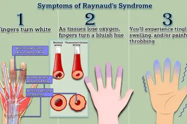 Groundbreaking Medical Discovery May Offer New Hope for Millions with Raynaud's Disease