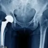 Investigation Reveals Potential Risk in Hip Implants: MHRA Alerts 2,000 Patients to Possible Malfunction