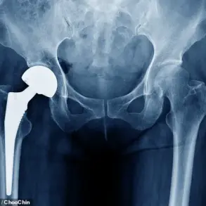 Investigation Reveals Potential Risk in Hip Implants: MHRA Alerts 2,000 Patients to Possible Malfunction
