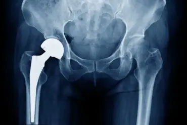 Investigation Reveals Potential Risk in Hip Implants: MHRA Alerts 2,000 Patients to Possible Malfunction