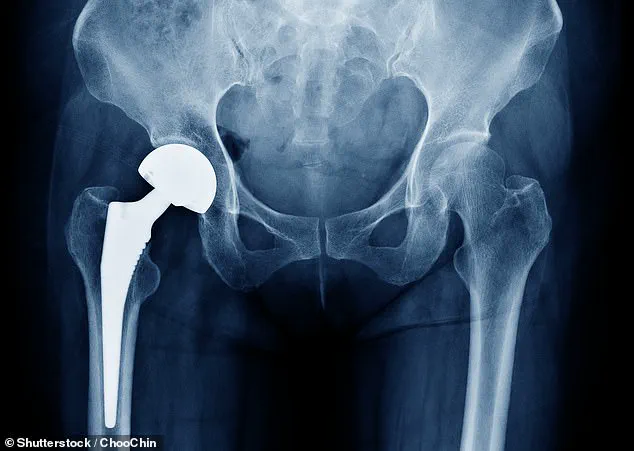Investigation Reveals Potential Risk in Hip Implants: MHRA Alerts 2,000 Patients to Possible Malfunction