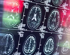 Johns Hopkins Study Reveals New Hope for Early Dementia Detection Using Advanced Brain Imaging