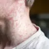 Measles Outbreak Linked to Utah Cycling Event: Four Unvaccinated Cases Confirmed, Officials Warn of More