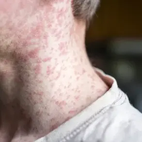 Measles Outbreak Linked to Utah Cycling Event: Four Unvaccinated Cases Confirmed, Officials Warn of More