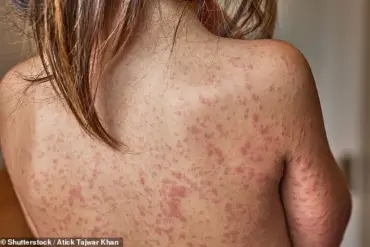 Mother Shares Experience of Toddler's Recovery from Common Chickenpox Infection