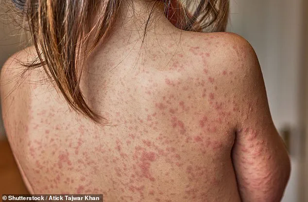 Mother Shares Experience of Toddler's Recovery from Common Chickenpox Infection