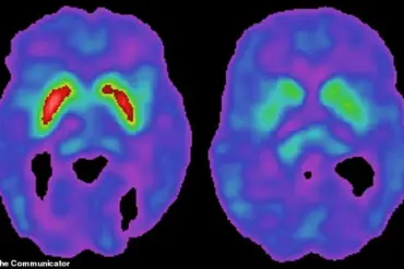 Study Reveals High Levels of Human Pegavirus in Parkinson’s Disease Brains